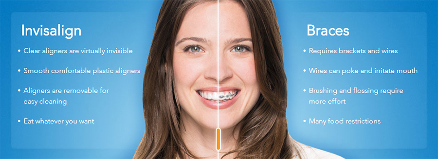 Invisalign Vs Braces Chart