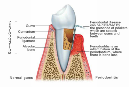 periodontal disease