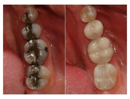 Tooth Filling